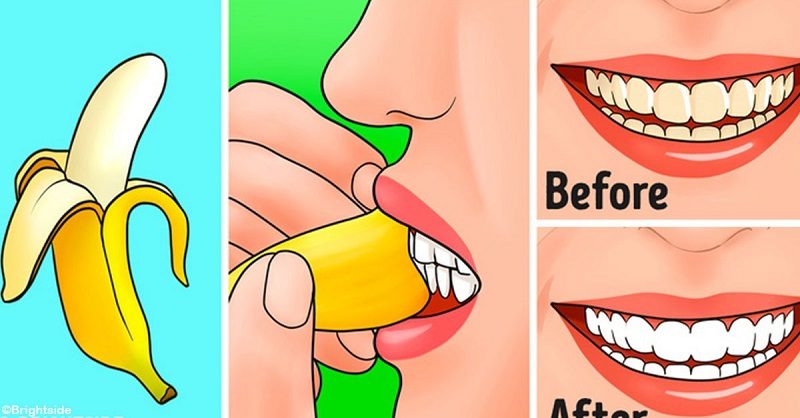 پوست موز برای سفید کردن دندان ها